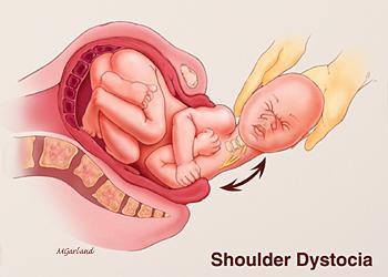 Shoulder Dystocia Lawyers